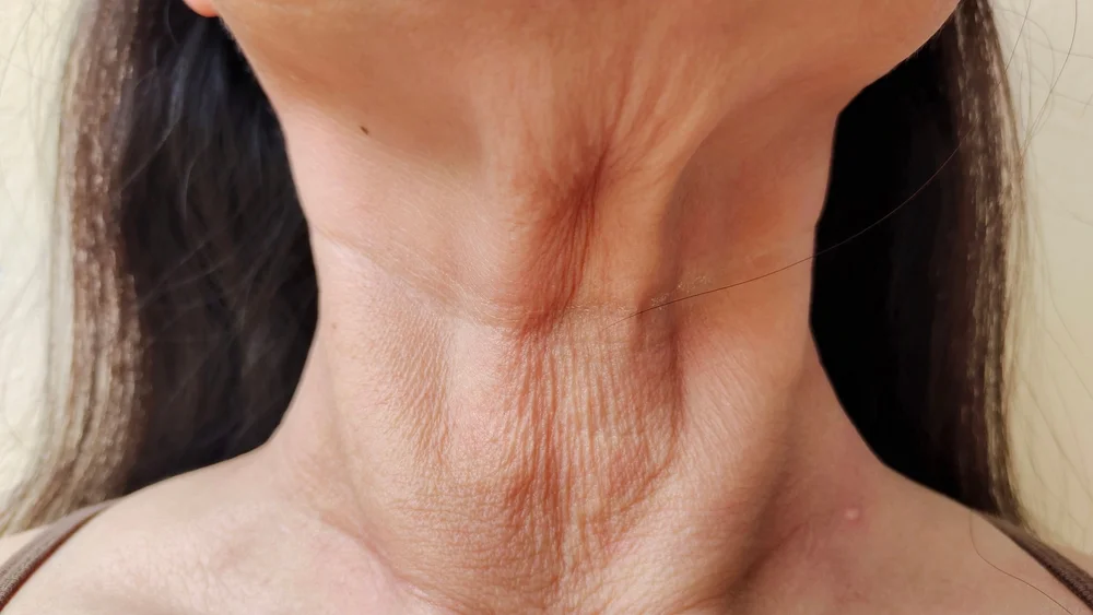 Loose Skin